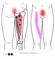 Adductor Magnus: Myofascial trigger points and associated pain locations