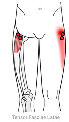 Tensor Fasciae Latae: Myofascial trigger points and associated pain locations