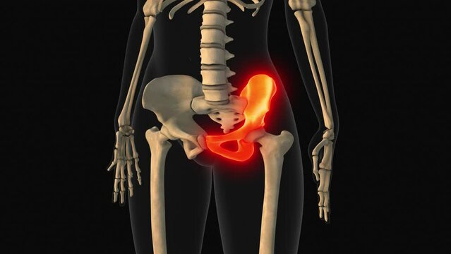 Medical animation of the hip bone pain