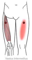 Vastus Intermedius: Quadriceps, Myofascial trigger points and associated pain locations - obrazy, fototapety, plakaty
