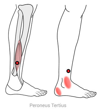 Peroneus Tertius: Myofascial trigger point and associated pain locations