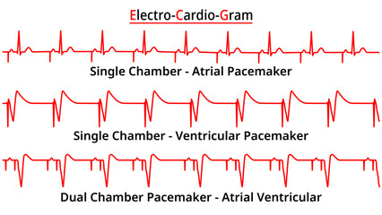 Set of ECG Common Abnormalities - Single vs Dual Chamber Pacemaker - Atrial Ventricular Rhythm - Electrocardiogram Vector Medical Illustration - obrazy, fototapety, plakaty