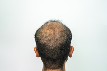 Rear view of bald spot of Asian men's head with hair loss problem.