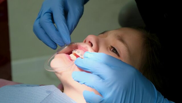 A dentist puts braces on the teeth of a young girl child. A dentist installs a retractor on a girl patient.