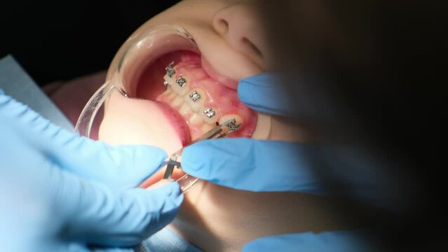 A dentist puts braces on the teeth of a young girl child. Close-up of an open mouth with optragate and on the tooth of the upper jaw is putting the ceramic brace.