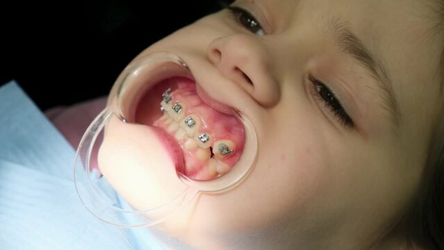A dentist puts braces on the teeth of a young girl child. Close-up of an open mouth with optragate and on the tooth of the upper jaw is putting the ceramic brace.