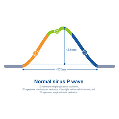 The illustration shows a normal sinus P wave recorded in a limb lead, with an amplitude of no more than 2.5 mm and a time limit of no more than 110 ms. - obrazy, fototapety, plakaty