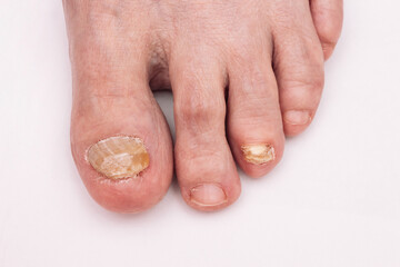 close-up photo of a human foot with nail plates affected by a fungal disease. Nail fungus. Onychomycosis. Dermatology. - obrazy, fototapety, plakaty