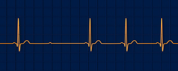 An ECG with 2nd degree Mobitz 2 AV block, 3D illustration