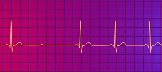 An ECG with 2nd degree Mobitz 2 AV block, 3D illustration