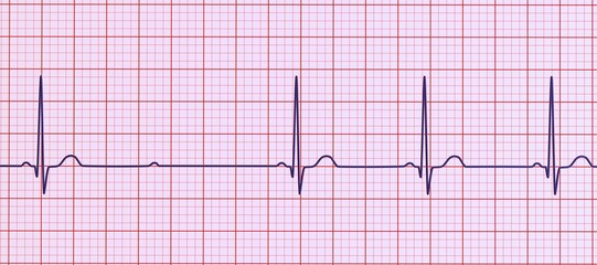 An ECG with 2nd degree Mobitz 2 AV block, 3D illustration