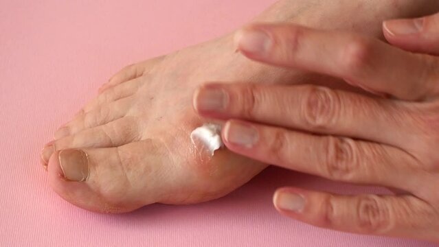 female legs with problem with women's feet, bunion toes in bare feet. Hallus valgus