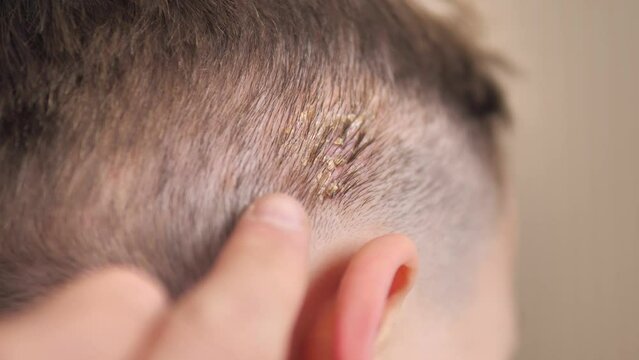 Host formation on the scalp of babies, host disease on the scalp,