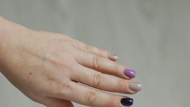 A woman's hand with a swollen finger from inflammation due to an infection caused by a torn nail, a finger with pus next to the nail of paronychia.