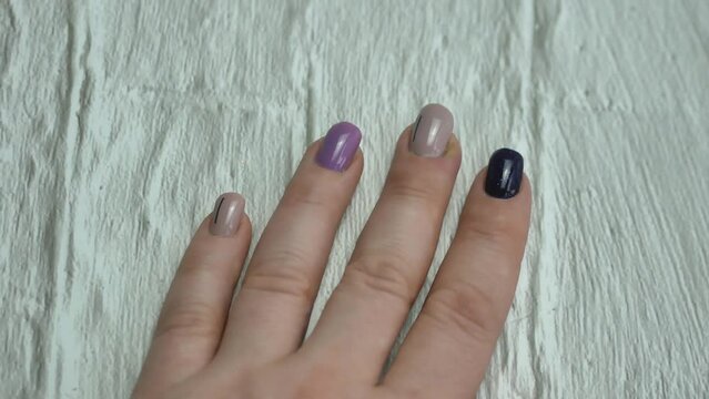 Paronychia is an inflammation of the periarticular roller. A purulent pillow near the nail on a woman's hand. Treatment of dermatological inflammations.