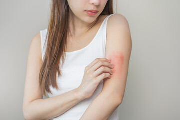 Dermatology asian young woman, girl allergy, allergic reaction from atopic, insect bites on her...