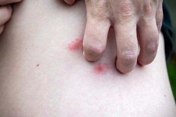 Naklejka premium Bites on the skin of a man.
