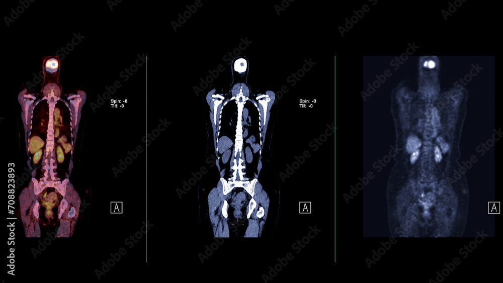 Poster a pet-ct scan image is a diagnostic visualization combining positron emission tomography (pet) and c