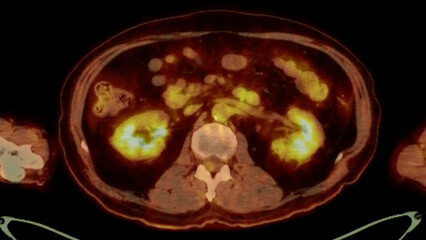 A PET-CT scan image is a diagnostic visualization combining Positron Emission Tomography (PET) and Computed Tomography (CT) for Helps in finding cancer recurrence.