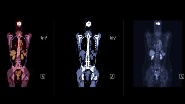 A PET-CT scan image is a diagnostic visualization combining Positron Emission Tomography (PET) and Computed Tomography (CT) for Helps in finding cancer recurrence.