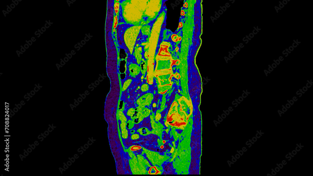 Poster ct scan of abdomen sagittal view with injection contrast media with green color mode coronal view fo