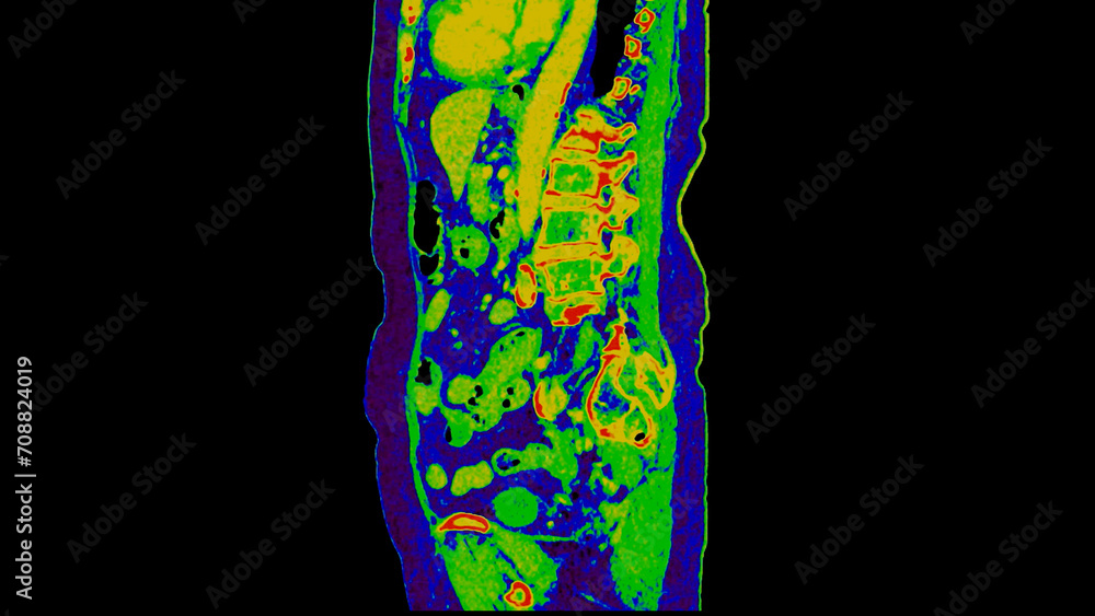 Poster ct scan of abdomen sagittal view with injection contrast media with green color mode coronal view fo