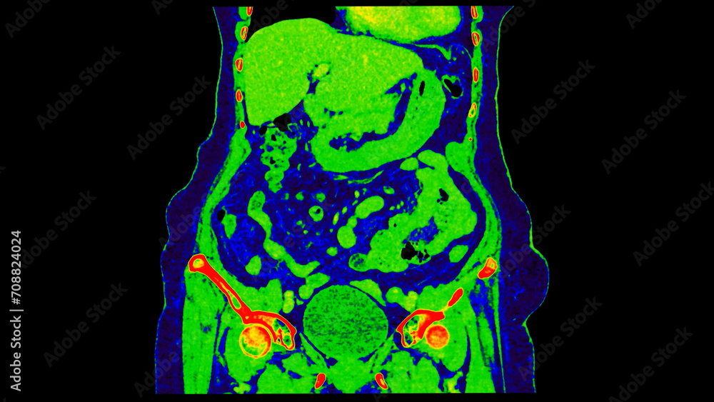 Poster ct scan of abdomen coronal view with injection contrast media with green color mode coronal view for