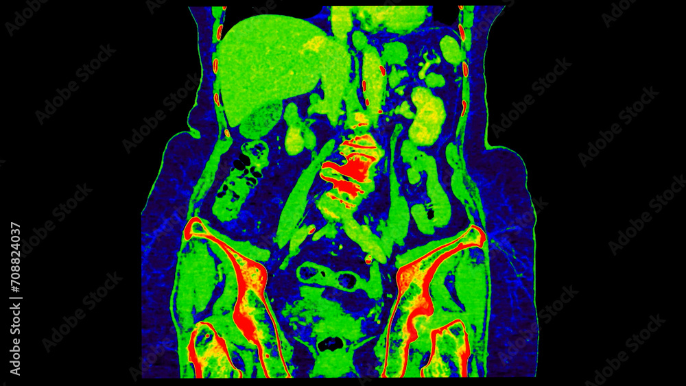Poster ct scan of abdomen coronal view with injection contrast media with green color mode coronal view for