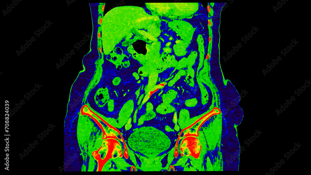 Poster ct scan of abdomen coronal view with injection contrast media with green color mode coronal view for