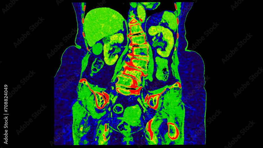 Poster ct scan of abdomen coronal view with injection contrast media with green color mode coronal view for