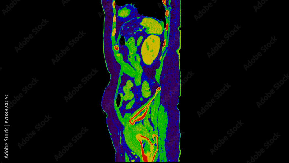 Poster ct scan of abdomen sagittal view with injection contrast media with green color mode coronal view fo