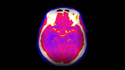 CT Brain Perfusion or CT scan image of the brain axial view .