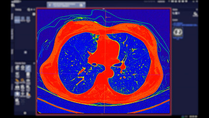CT scan of Chest Axial view in color mode  for diagnostic Pulmonary embolism (PE) , lung cancer and covid-19.