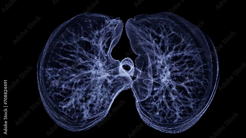 Poster ct chest or lung 3d rendering image showing trachea and lung in respiratory system..