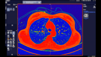 CT scan of Chest Axial view in color mode  for diagnostic Pulmonary embolism (PE) , lung cancer and covid-19.