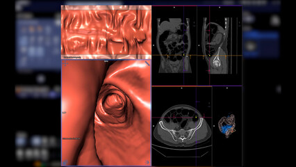 CT colonography , This imaging technique is often employed for colorectal cancer screening, providing detailed images of the colon's interior 3D rendering.