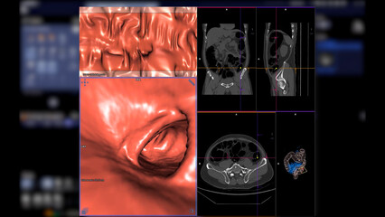 CT colonography , This imaging technique is often employed for colorectal cancer screening, providing detailed images of the colon's interior 3D rendering. - obrazy, fototapety, plakaty