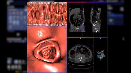 CT colonography , This imaging technique is often employed for colorectal cancer screening, providing detailed images of the colon's interior 3D rendering.
