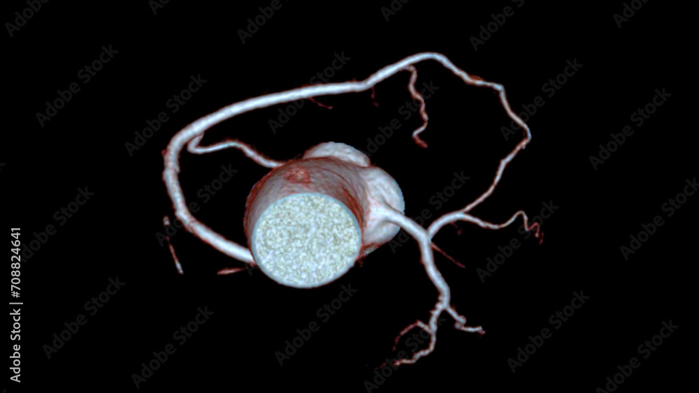 Poster cta coronary artery 3d rendering is a diagnostic imaging technique capturing detailed visuals of the