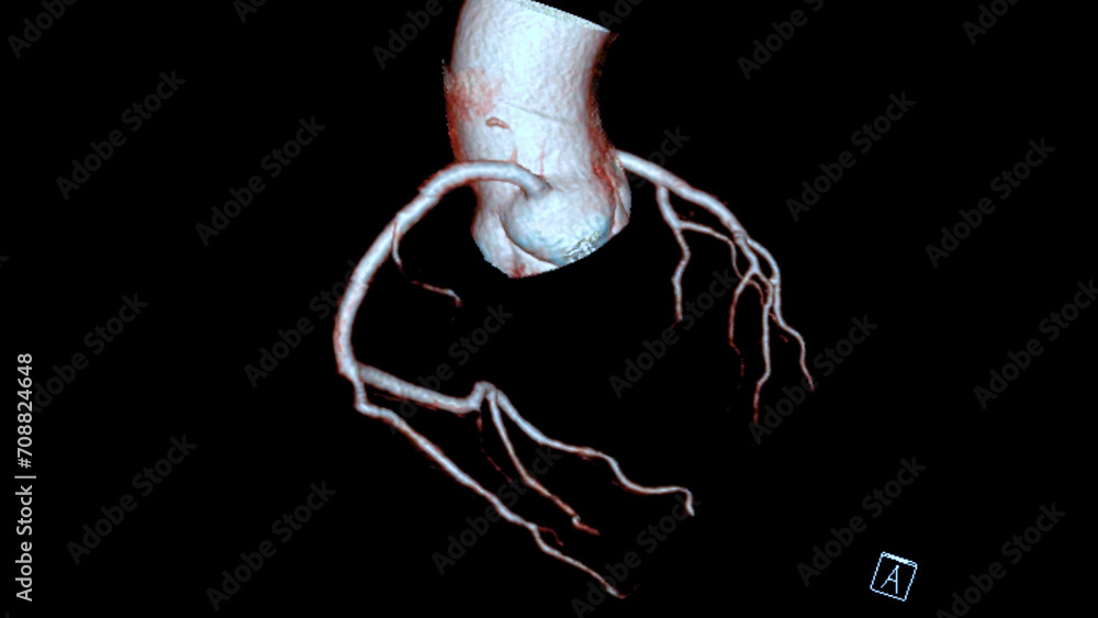 Aufkleber cta coronary artery 3d rendering is a diagnostic imaging technique capturing detailed visuals of the