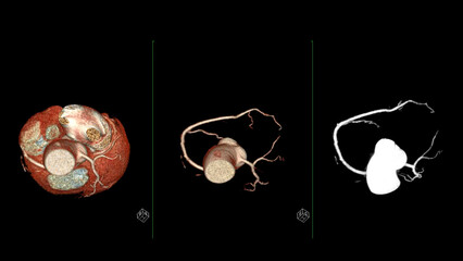 CTA coronary artery 3D rendering is a diagnostic imaging technique capturing detailed visuals of the heart's blood vessels in diagnosing coronary artery diseases and assessing cardiac health. - obrazy, fototapety, plakaty