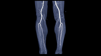 CTA femoral artery run off image of femoral artery for diagnostic Acute or Chronic Peripheral Arterial Disease.