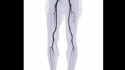 CTA femoral artery run off image of femoral artery for diagnostic Acute or Chronic Peripheral Arterial Disease. - obrazy, fototapety, plakaty