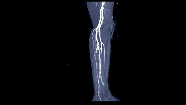 CTA femoral artery run off image of femoral artery for diagnostic Acute or Chronic Peripheral Arterial Disease.