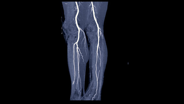 CTA femoral artery run off image of femoral artery for diagnostic Acute or Chronic Peripheral Arterial Disease.