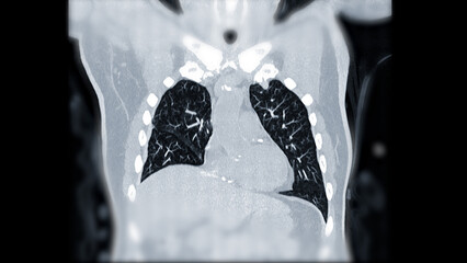 CTPA or CTA pulmonary artery .This imaging technique offers a clear view of the pulmonary arteries, aiding in the diagnosis of pulmonary embolism, vascular conditions, and other respiratory issues. - obrazy, fototapety, plakaty