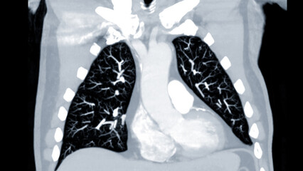 CTPA or CTA pulmonary artery .This imaging technique offers a clear view of the pulmonary arteries, aiding in the diagnosis of pulmonary embolism, vascular conditions, and other respiratory issues.