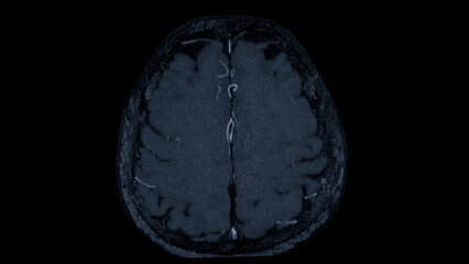 MRA Brain axial view , This imaging technique provides clear visuals of the brain's arterial and venous structures, aiding in the diagnosis of vascular conditions and neurological issues.