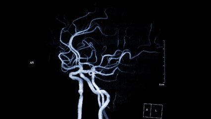 MRA Brain , This imaging technique provides clear visuals of the brain's arterial and venous...