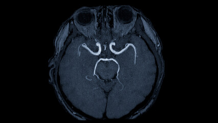MRA Brain axial view , This imaging technique provides clear visuals of the brain's arterial and...